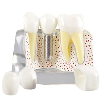  Демонстрационная модель зубов Имплантат Съемный анализный корончатый мост для общения с пациентом